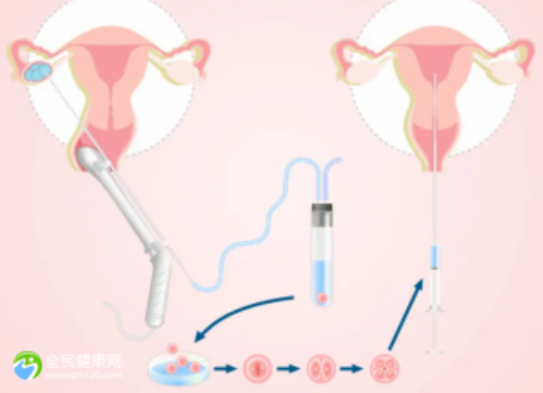 怎样提高试管婴儿的成功率